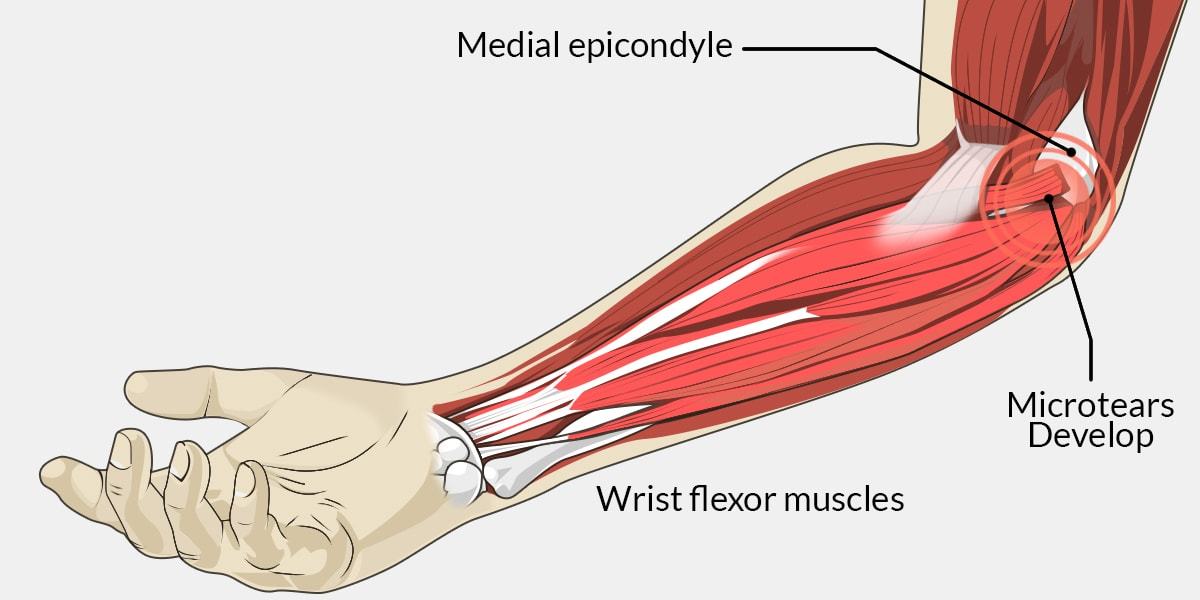 Golfer’s Elbow